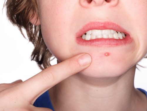 acne under the mouth